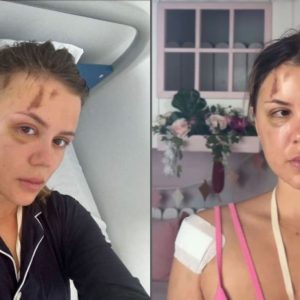 Emily Burghelea a răbufnit după ce Radu Ciucă a acuzat-o că și-a înscenat accidentul din Mauritius: „Am purtat săptămâni întregi o atelă metalică în cap și am petrecut o lună întreagă fără să îmi pot lua copiii în brațe”