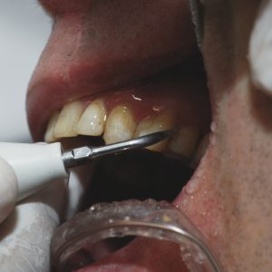 Medic stomatolog, avertisment despre curățarea tartrului acasă, prin metode virale pe TikTok. De ce e periculos: „Pot apărea afecțiuni!”