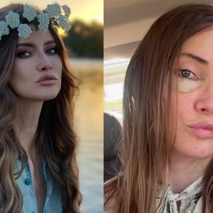 Iulia Albu și-a făcut lifting facial, la 44 de ani. Cum arată după operația estetică: „Procedura a reprezentat primul pas, urmat de un protocol de recuperare, perfuzii și tratamente”